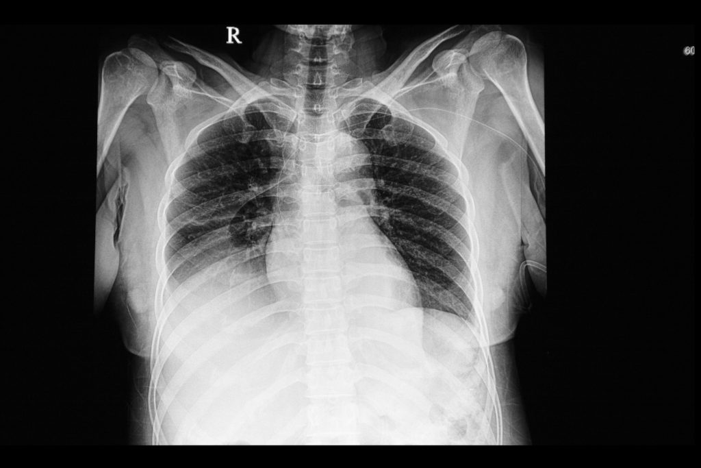 A chest xray film of a patient with right lung pleural effusion. A right heart venous catheter is also shown.